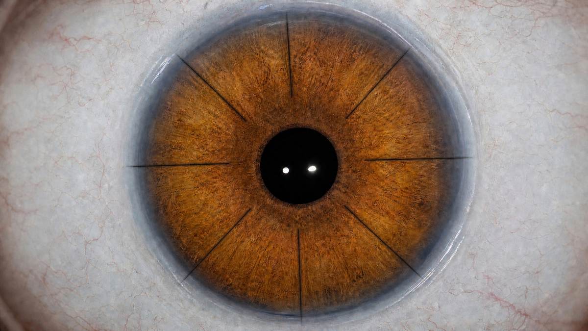 Close-up of a cornea showing eight radial incisions running from the outer edge toward a clear central zone, the spoke-like pattern left by radial keratotomy.