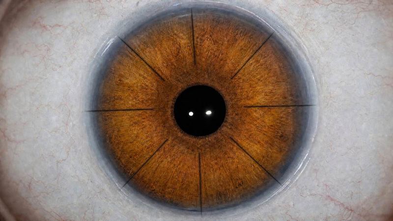 Close-up of a brown eye showing the radial incision lines left by RK surgery
