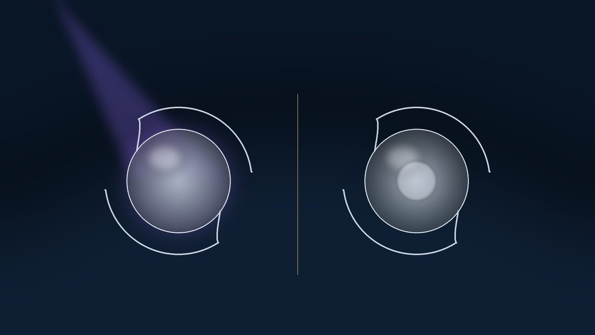 Two cataract lens implants side by side on a dark surface, the left one under a violet beam of light, each a round smooth optic with two curved haptic arms