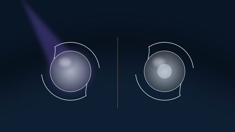 Two cataract lens implants side by side on a dark surface, the left one under a violet beam of light, each a round smooth optic with two curved haptic arms