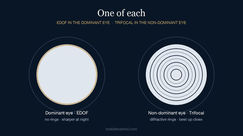Diagram of an EDOF lens for the dominant eye beside a trifocal lens for the non-dominant eye